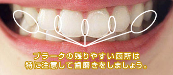 プラークは奥歯や歯と歯の間に残りやすいです。